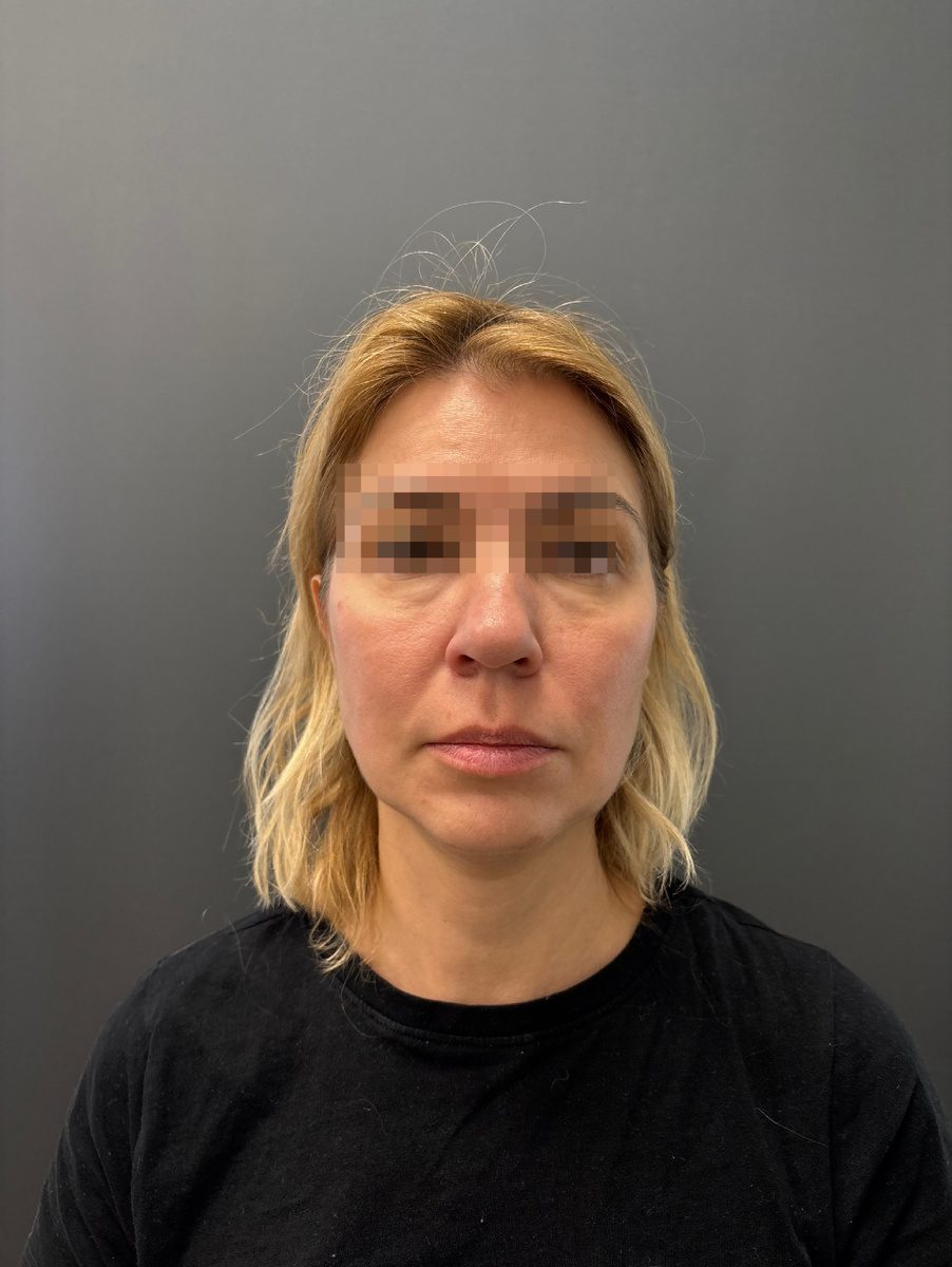 Нос пациентки до операции: не устраивает ширина кончика и его опущение, не хватает обьема мягких тканей в подкончиковой зоне