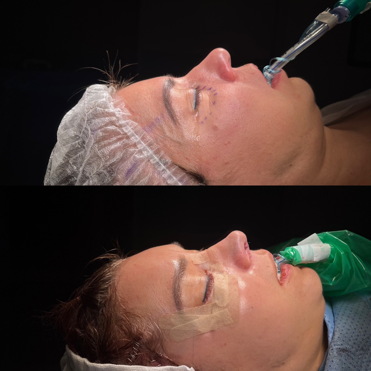 Пластика кончика носа: результат сразу на операционном столе. Хирург Остринская Т.В.