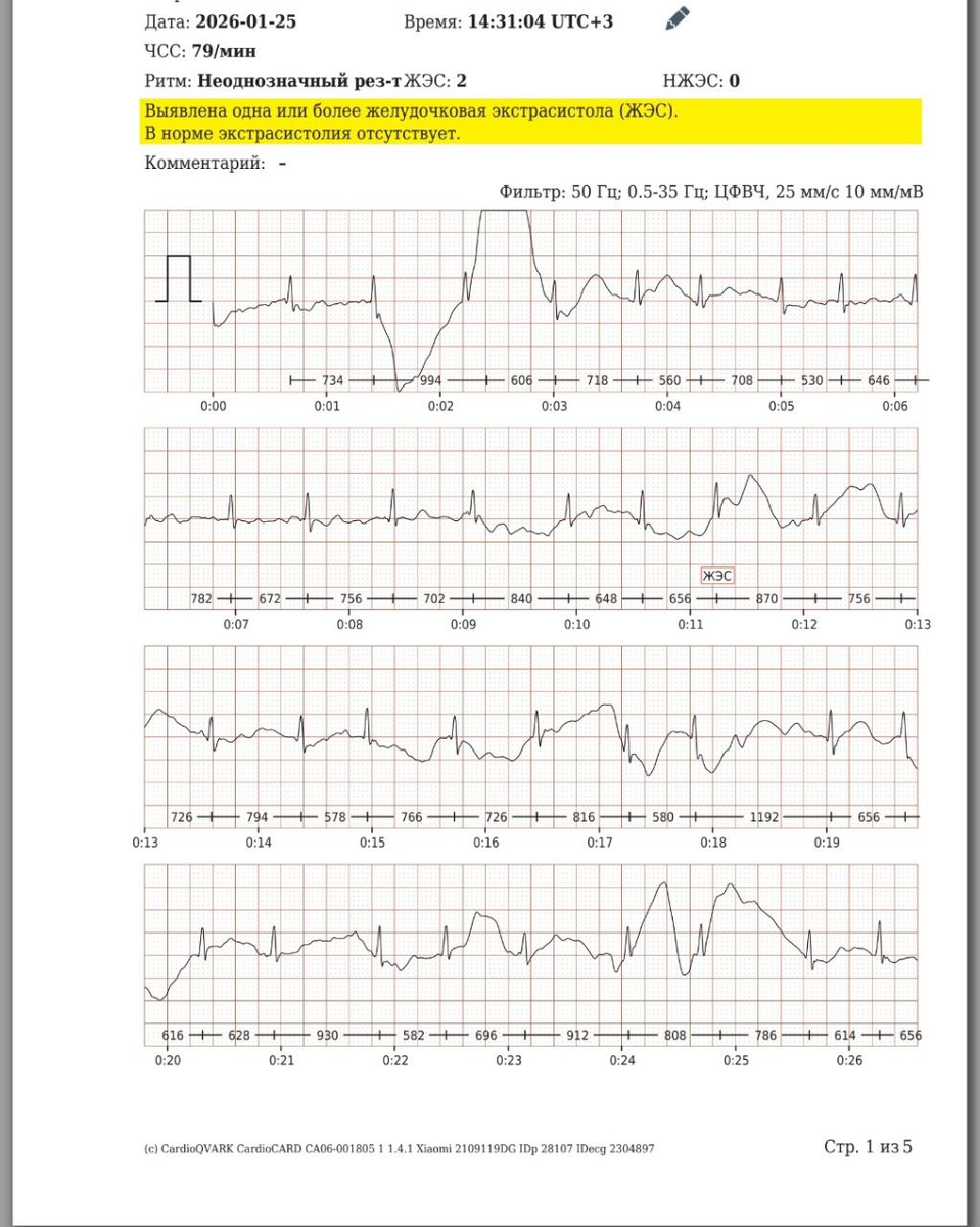 Представлены результаты ЭКГ-исследования снятые с помощью КардиоКАРТЫ во время желудочковой экстрасистолии.