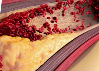 Холестерин (жёлтый).