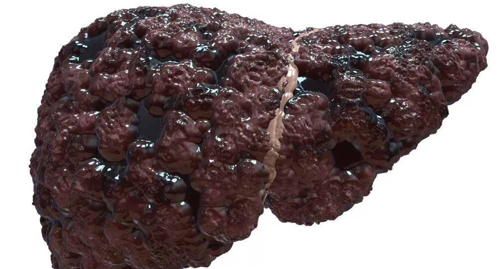 Цирроз печени: как распознать, остановить и жить дальше