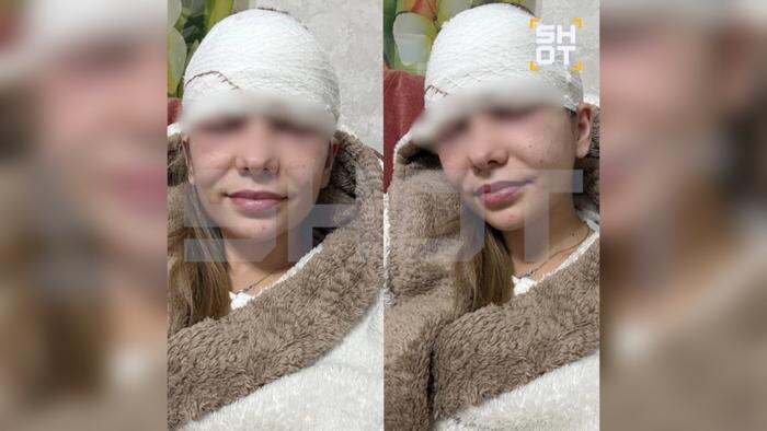 Россиянке потребовалось операция после того, как она выдавила прыщ на лбу. Фото © SHOT