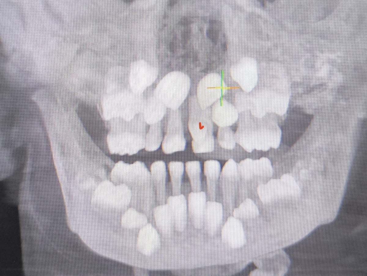 -2
