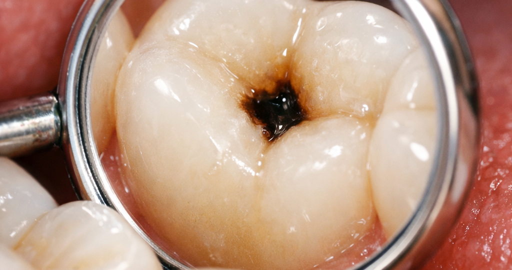 Причины кариеса: откуда он берётся и почему появляется даже при чистке зубов