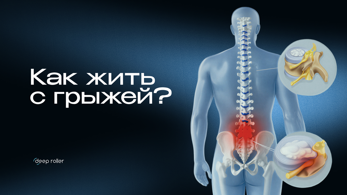 Как жить с протрузией? 