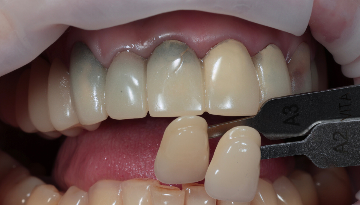 Старые временные коронки из PMMA