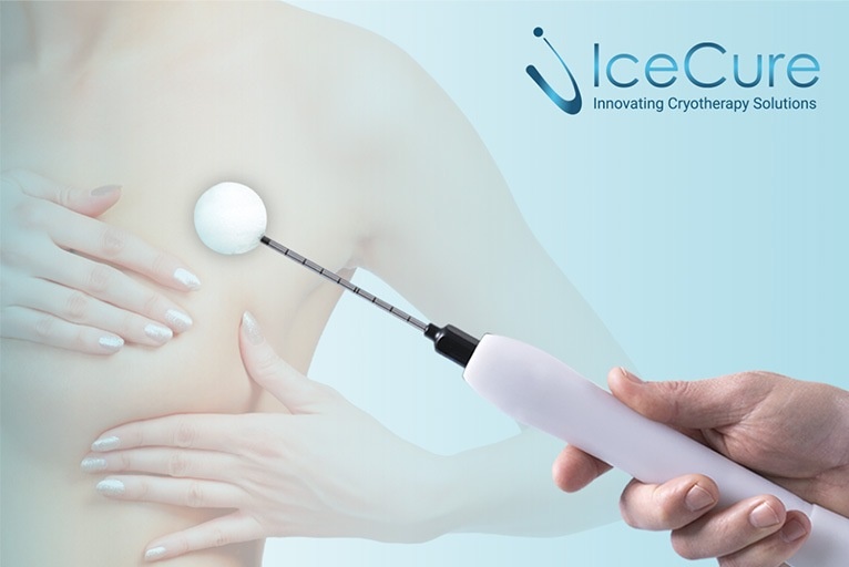 Израильская технология замораживания опухолей