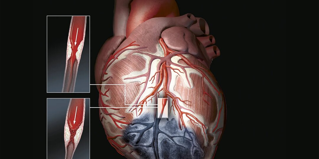 Инфаркт не ждёт выходных: правда о том, как он приходит и как его обмануть
