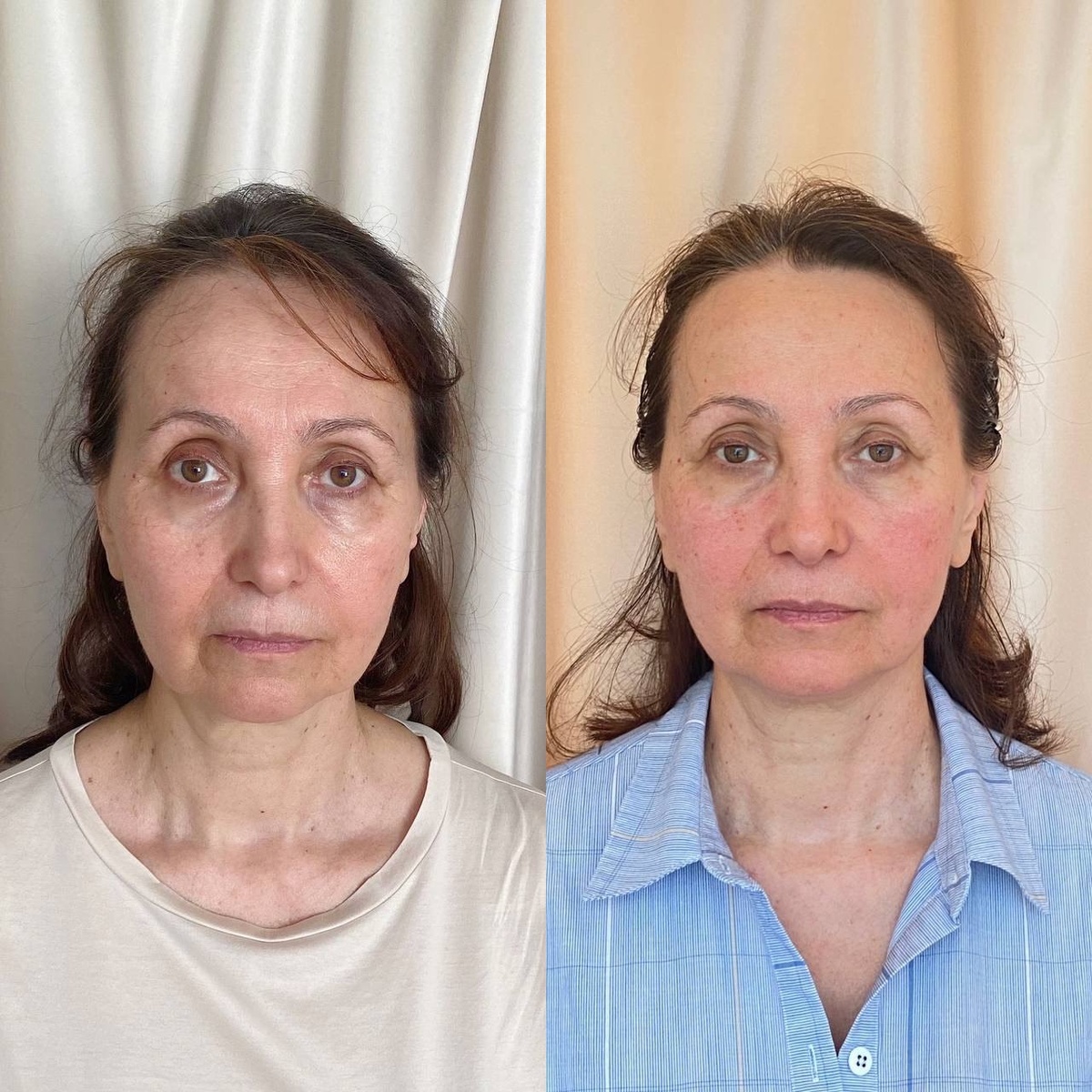 Результат одного сеанса Гуаша лица методом доктора Ковбашиной