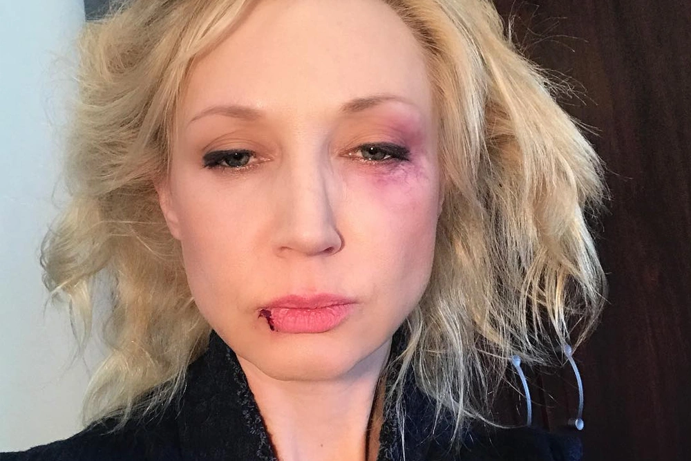 следы побоев на лице очевидны