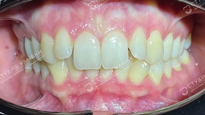 Дистальный прикус до ортодонтического лечения. Листайте галерею, чтобы увидеть больше фото. 