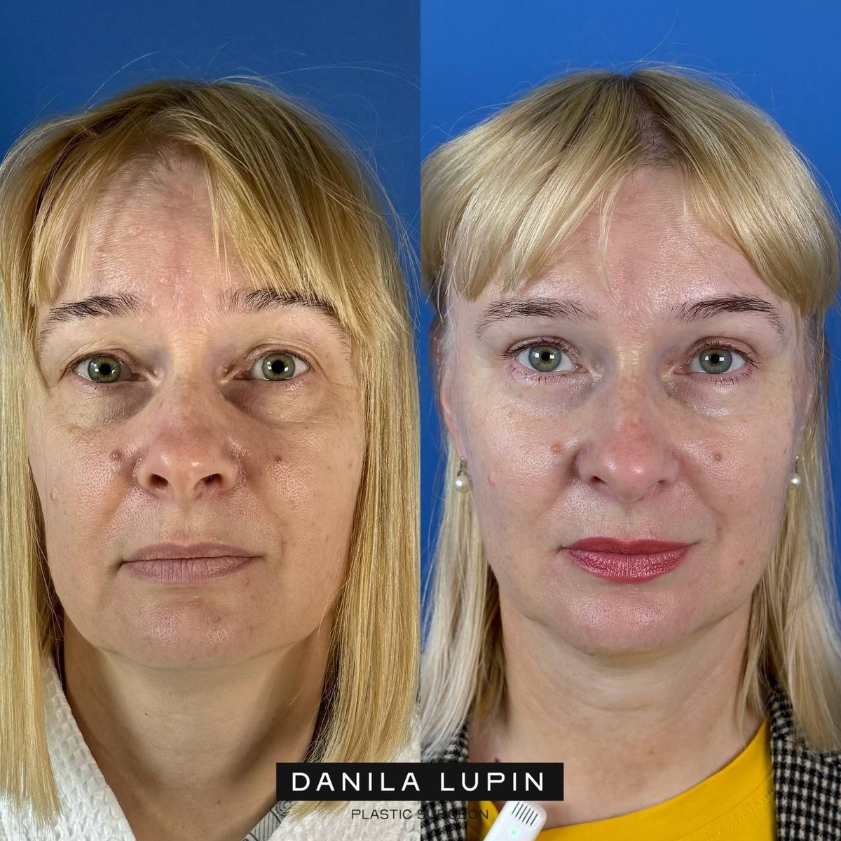 Моя пациентка. Выполнили эндоскопическую подтяжку лобно-височной области с блефаропластикой. Облик стал свежее, вид отдохнувший