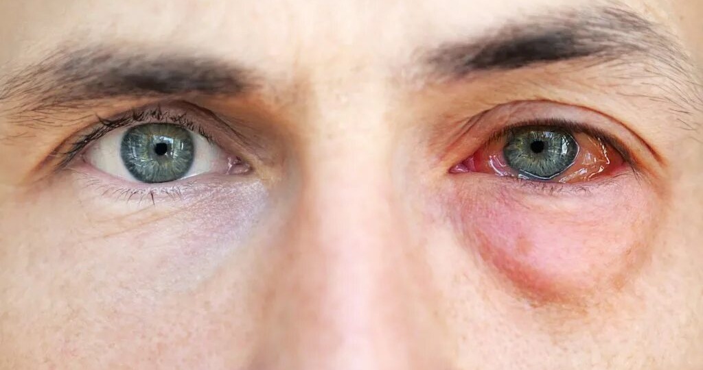 Глаза горят, чешутся, слезятся: что делать, когда конъюктивит стучится в дверь вашей жизни?