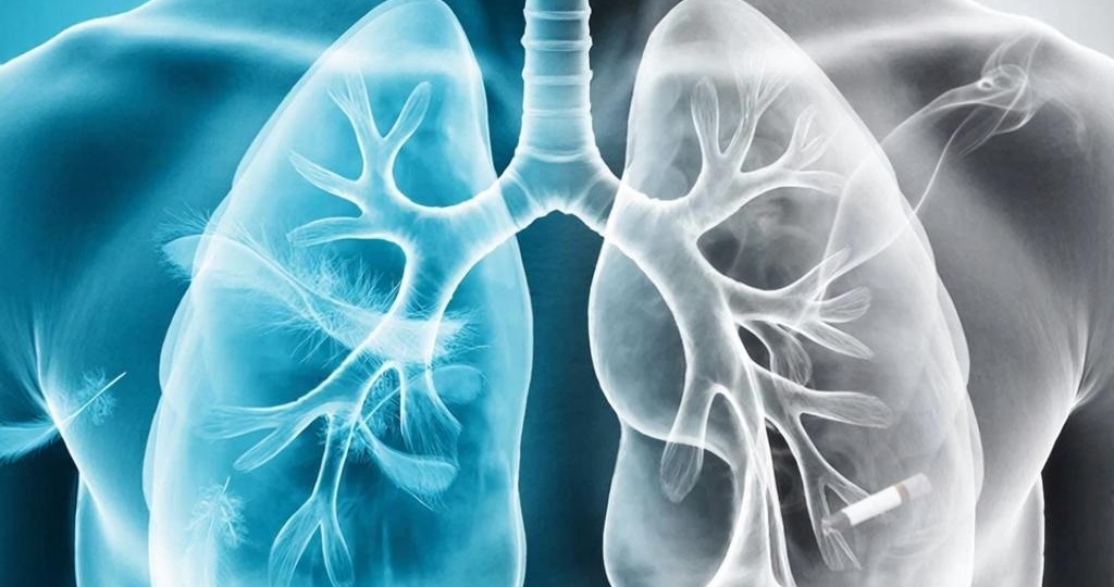 «Не могу дышать»: как отличить приступ астмы от обострения ХОБЛ? Ищем ключевые различия