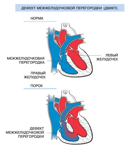 Дефект межжелудочковой перегородки. Источник: bosti.kg