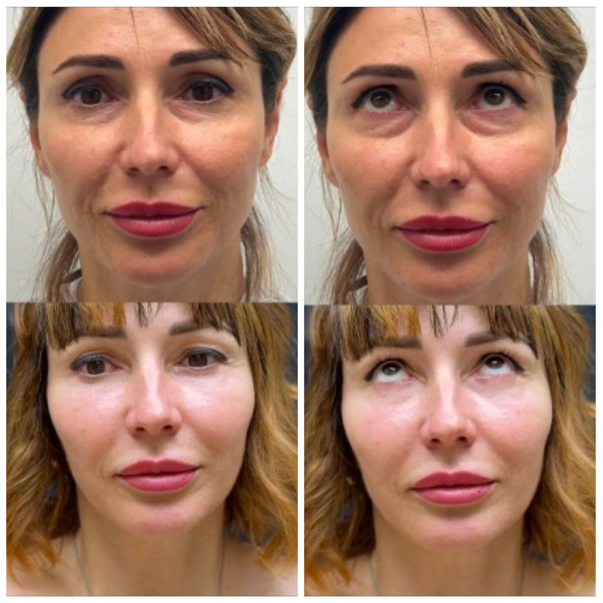 1,5 месяца после нижней блефаропластики