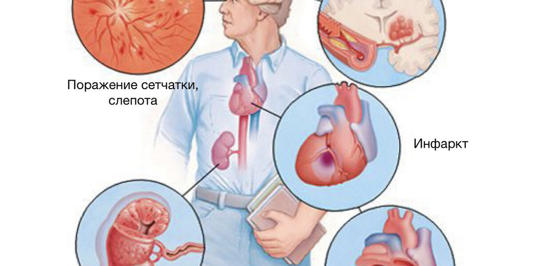 Артериальная гипертензия: почему лечение не всегда работает?