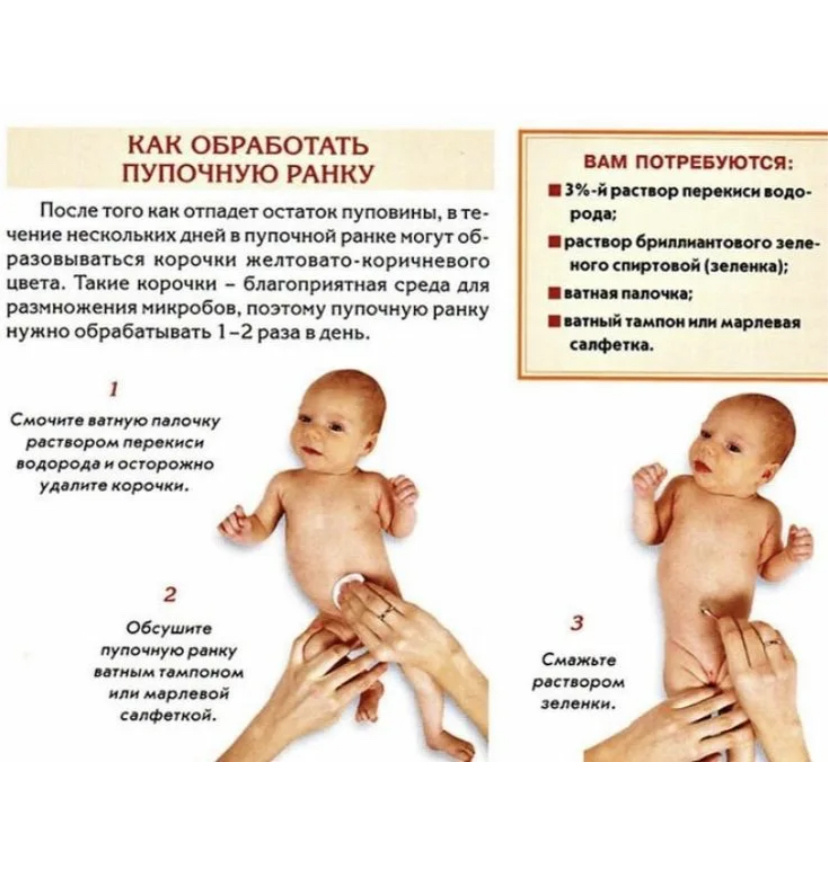 Обработка пупочной раны новорожденного