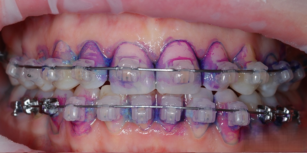 Индикация налета, интенсивоно окрашенные участки - выраженный налет