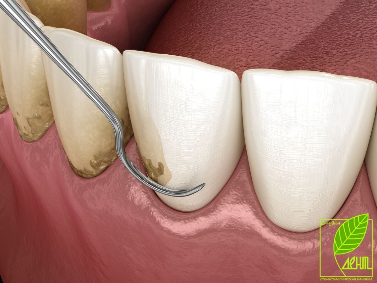 Зубной налет как что почему?

