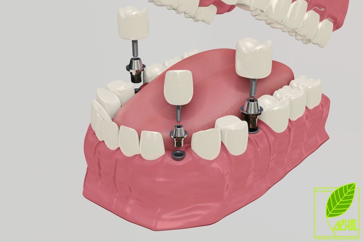 Вставить зуб сразу или подождать?

