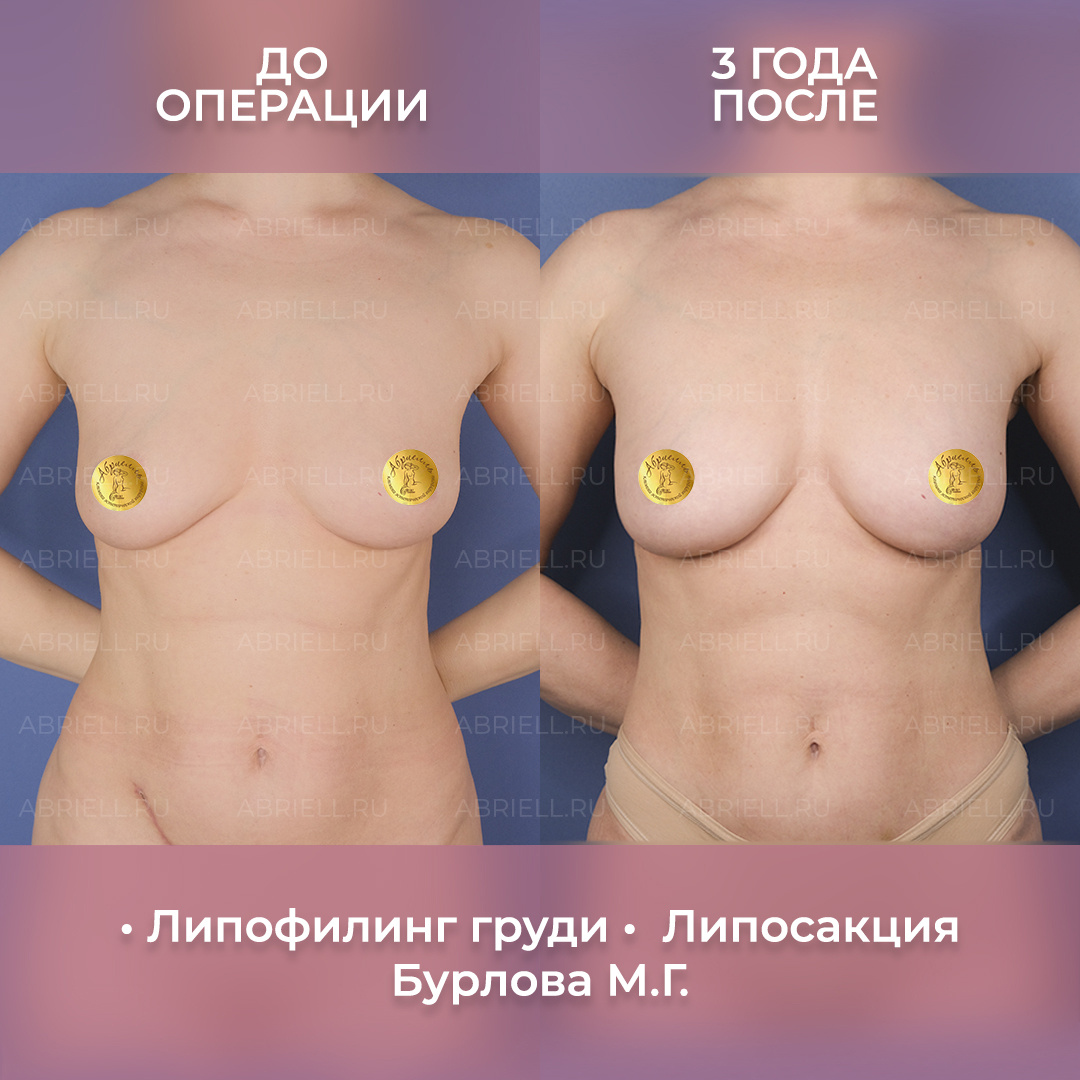 Результат увеличения груди собственным жиром - методом липофилинга с липосакцией. Результат до и через 3 года после операции. Пластический хирург в Санкт-Петербурге Бурлова Левицкая Мария Григорьевна Клиника Абриелль 