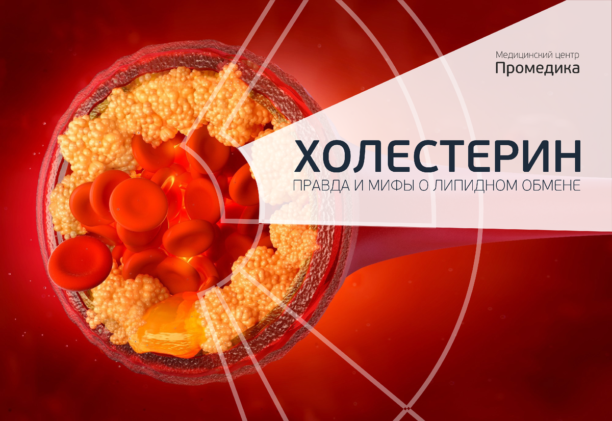Холестерин и сосуды. Правда и мифы о липидном обмене