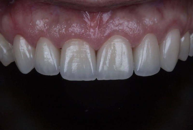 Установка виниров — это не просто косметическая процедура, а искусство, которое требует высокой квалификации и опыта