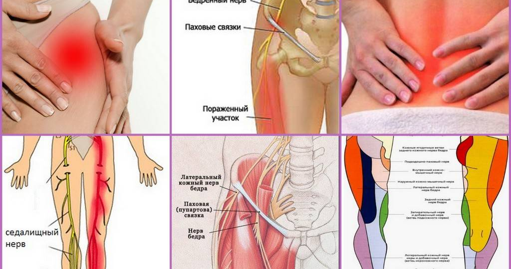 Поясничные боли отдают в ягодицу