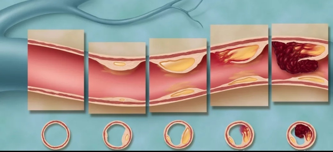 Сколько времени растет холестериновая бляшка: от первой молекулы до сосудистой катастрофы