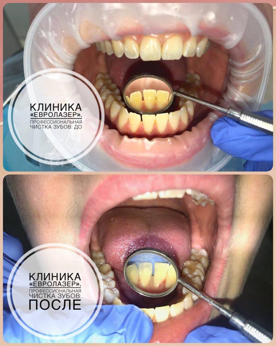 Проф.гигиена полости рта: до и после