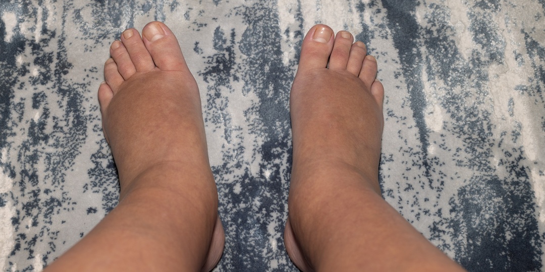 Как понять, что сосуды в плохом состоянии. 12 сигналов, которые они посылают вам каждый день