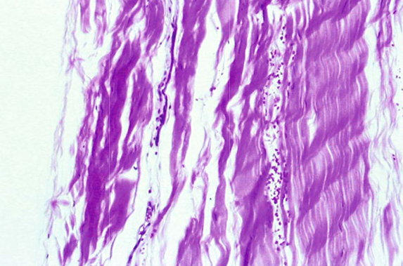 на изображении показно изменение тканей  сухожилиях 