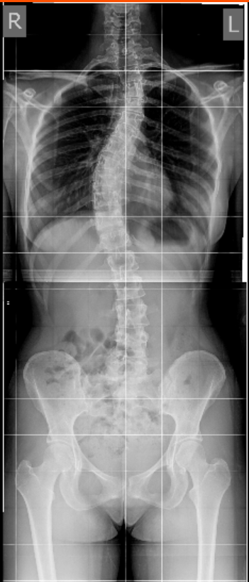 Сколиоз до операции. Основная дуга 45 градусов.