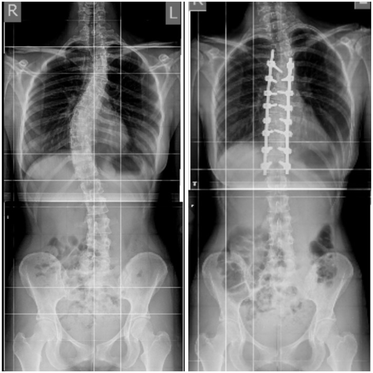 До и после коррекции сколиоза в больнице Вредена.