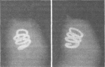 Рентгенограмма полового члена с инородным телом