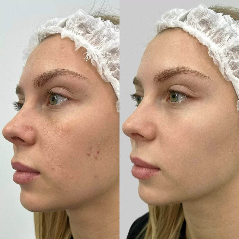 Результат нашей пациентки после коллагенотерапия