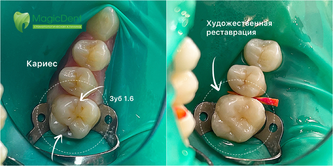 Подготовка к ортодонтии