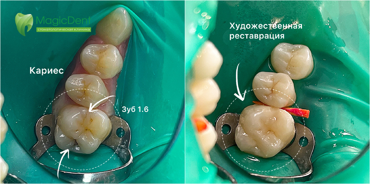 Кариес дентина 16 зуба