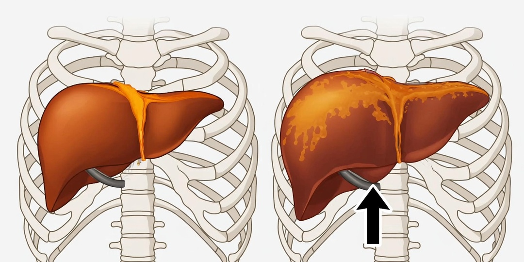 Увеличенная печень и гепатоз: почему нельзя откладывать визит к врачу?