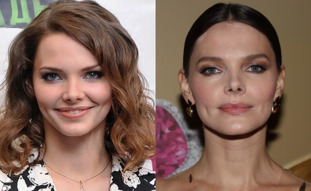 на фото Елизавета Боярская до после пластики