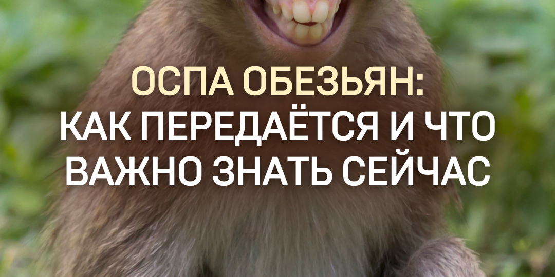 ОСПА ОБЕЗЬЯН: очередная пандемия?