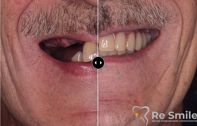 Пациент обратился с жалобами на частичное отсутствие зубов, их подвижность и неудовлетворительный эстетический вид на верхней и нижней челюстях.

Было проведено удаление оставшихся зубов на обеих челюстях с одновременной установкой дентальных имплантатов по одноэтапному протоколу. На 4-й день после операции выполнена фиксация условно-съемных адаптационных протезов на верхнюю и нижнюю челюсти.
