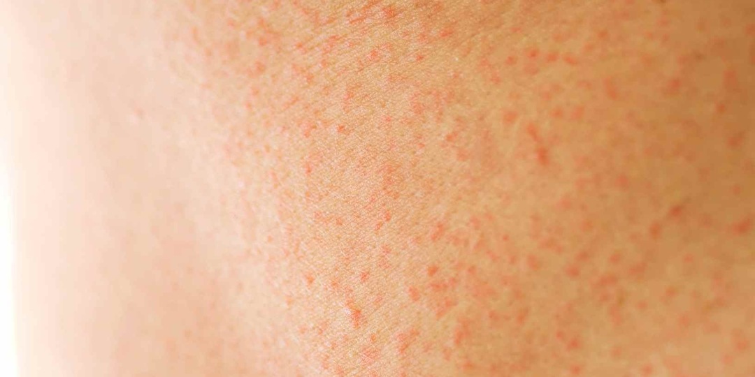 Высыпания, которые не проходят месяцами — не всегда проблема кожи