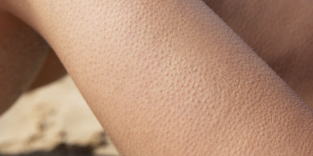 Ощущение «ползания» по коже без видимых причин