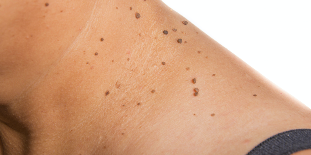 Появилось много маленьких папиллом — что часто находят у людей 50+