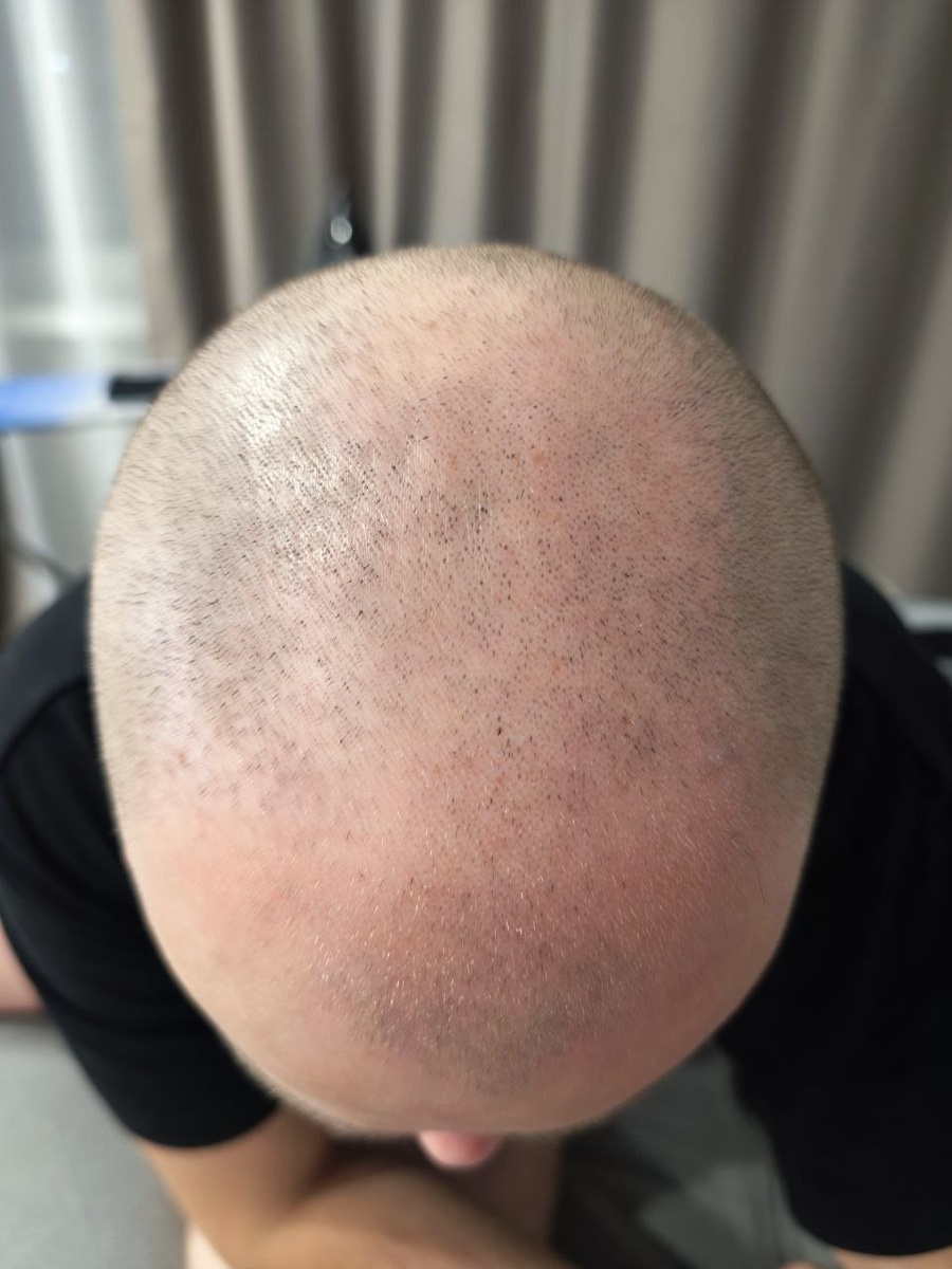 До использования миноксидила