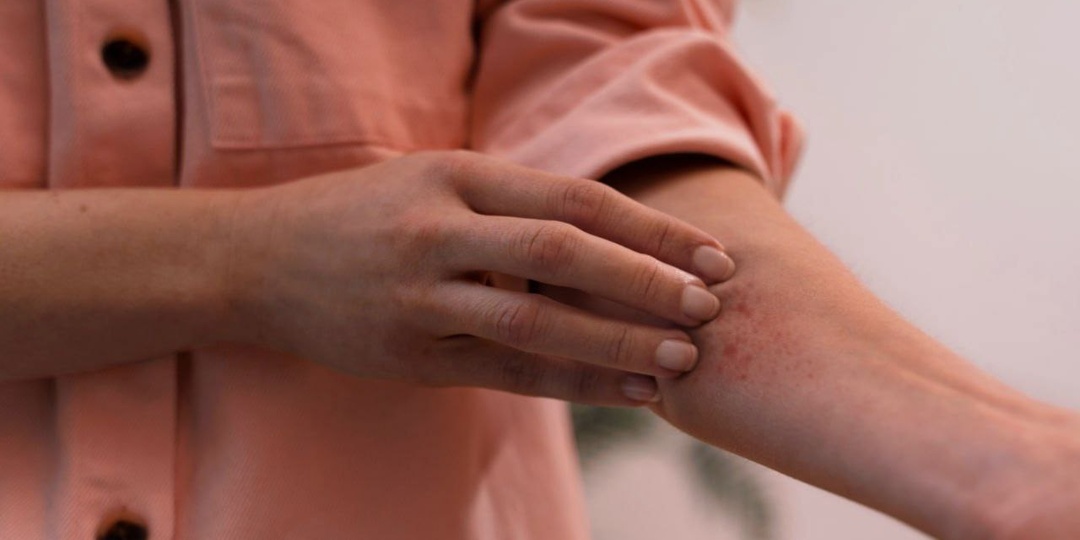 Псориаз: причины, симптомы и методы поддержки кожи