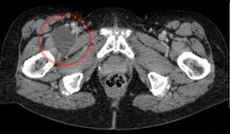 Изображение  демонстрирует значительное увеличение подвздошно-поясничной сумки справа (слева на изображении, выделена кругом) на компьютерной томограмме.