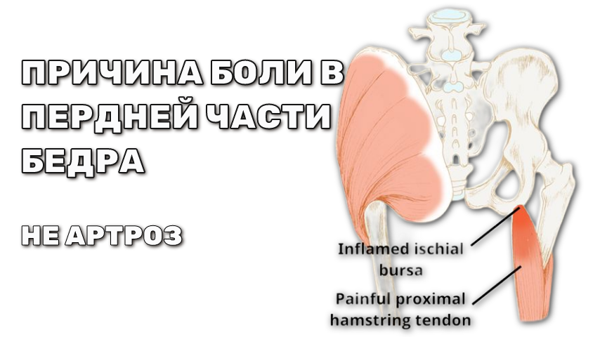 Боль в передней части бедра, около тазобедренного сустава.